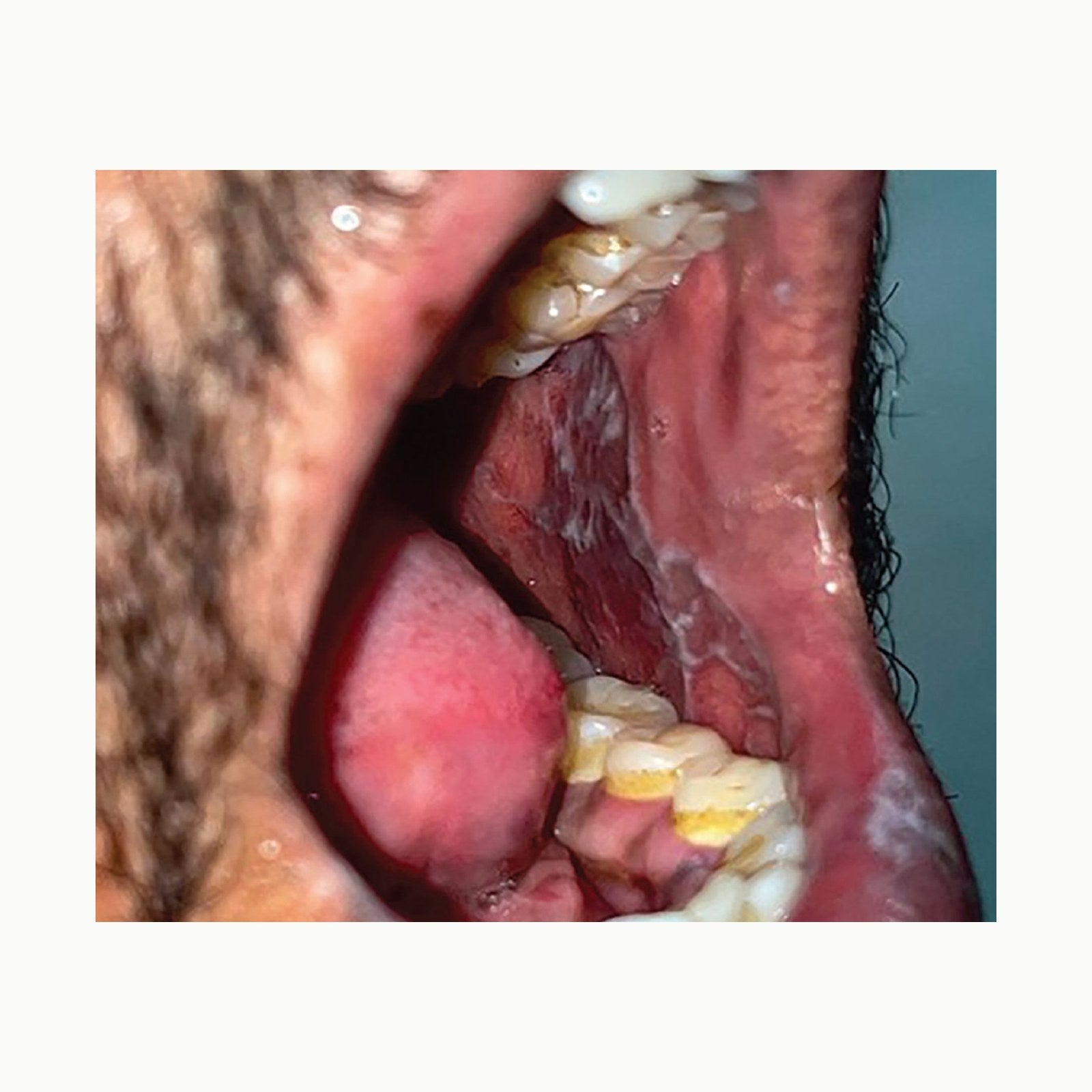 Oral-B Oral Health Center Munddusche, 2 Ersatzdüsen, Zahnzwischenraumr